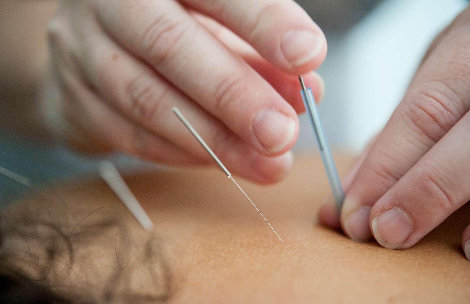 Medic acupunctor Dr. Dalibor Pavlisan - acupunctura clasica chineza in Timisoara