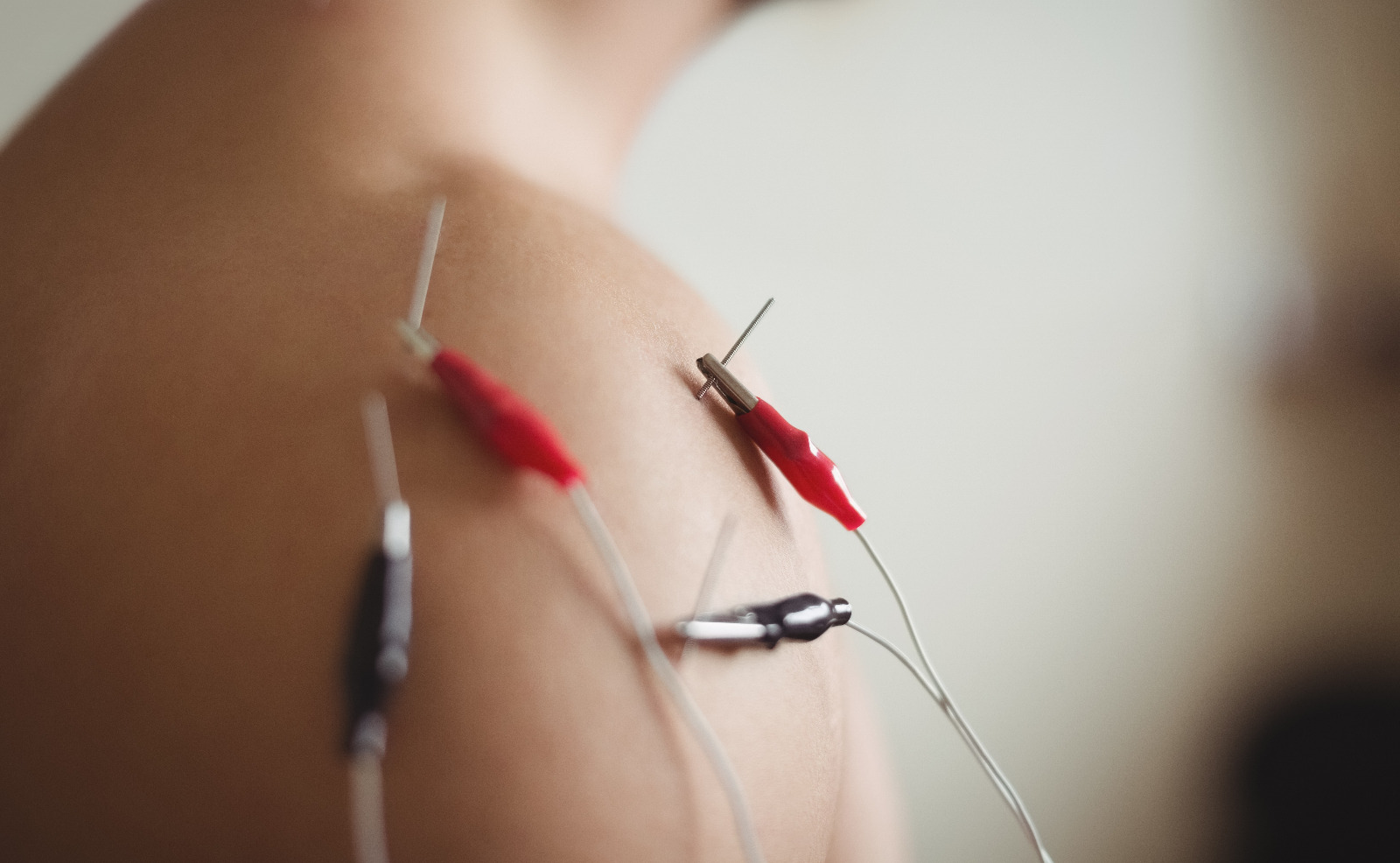 Electroacupunctura - tratament acupunctura Timisoara